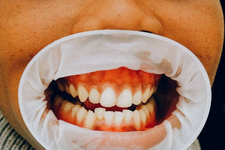 Consequências da má oclusão dentária