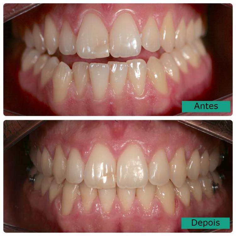 Consequências da má oclusão dentária
